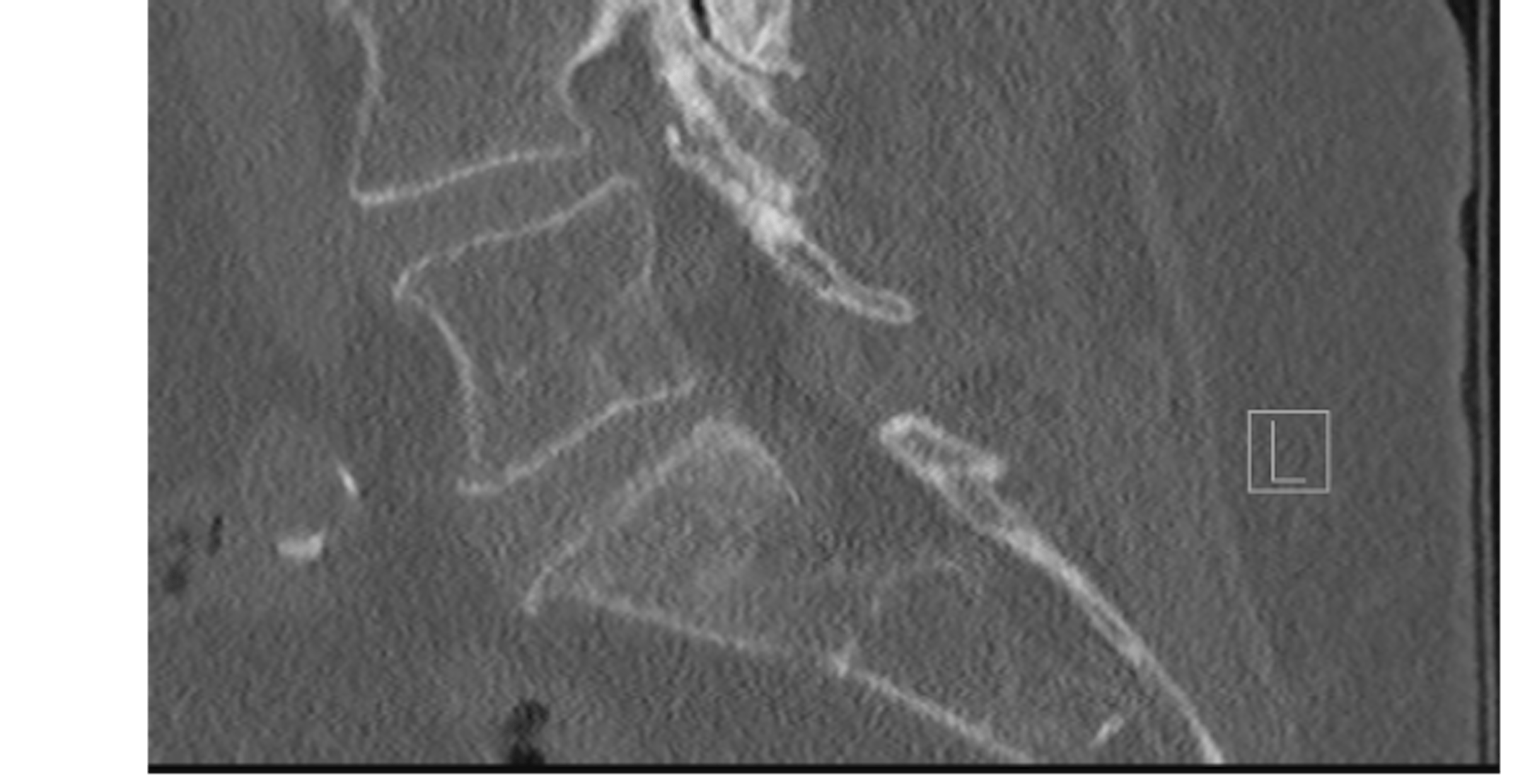 Indeukingsfractuur D12 botvenster f1586263308