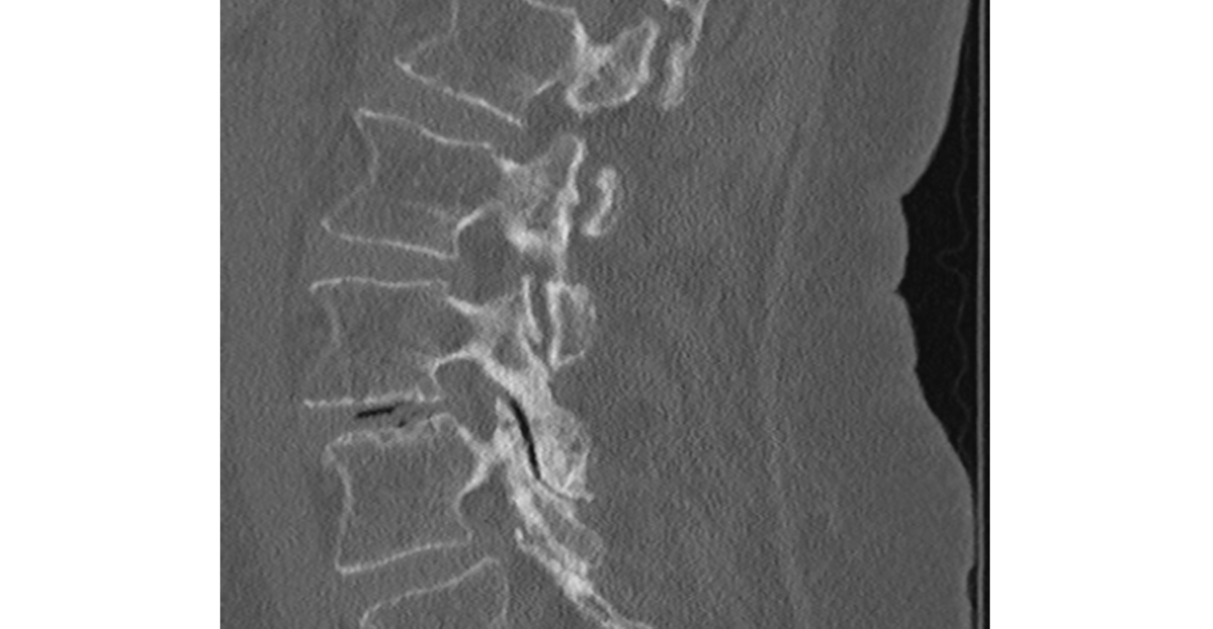 Indeukingsfractuur D12 botvenster